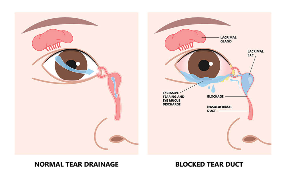 Chart Illustrating a Blocked Tear Duct