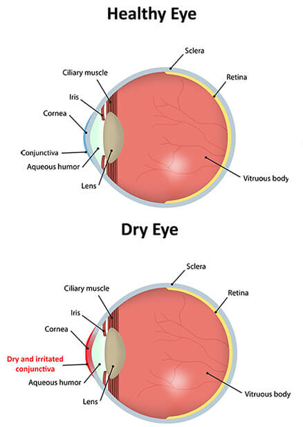 Chart Ilustrating a Healthy Eye Compared To One Experiencing Dry Eye