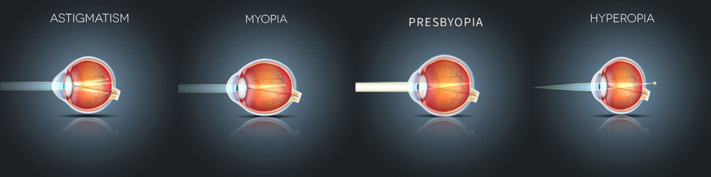 Chart Illustrating How Astigmatism, Myopia, Presbyopia and Hyperopia Affect Eye Sight